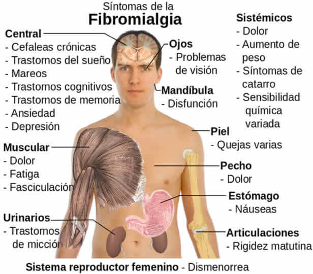 fibromialgia