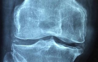 Condromalacia rotuliana